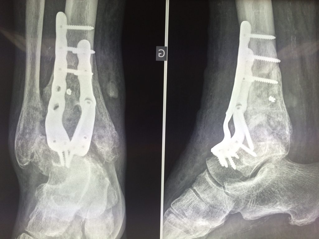 Arthrodèse de cheville ChirurgieAtlantiqueduPied — free download