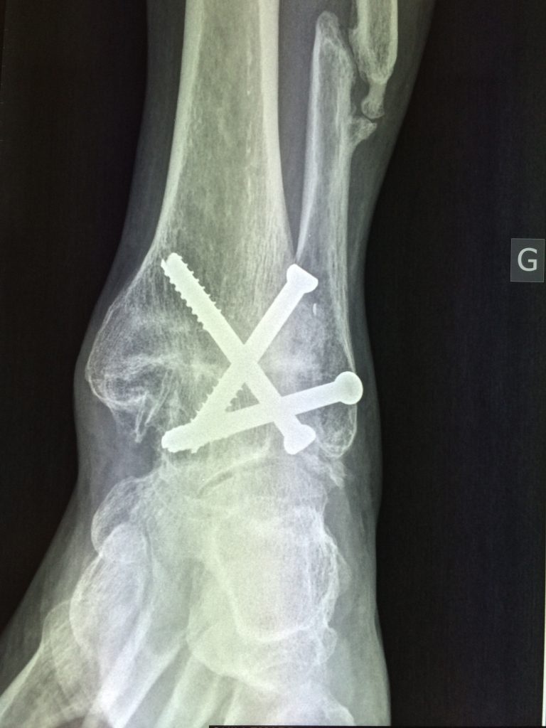 Arthrodèse de cheville | Chirurgie-Atlantique-du-Pied